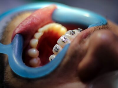 Braces