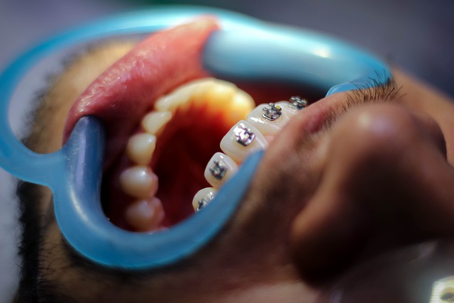 Braces